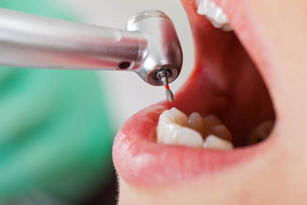 Best Emergency Wisdom Teeth Removal in Mishawaka, IN